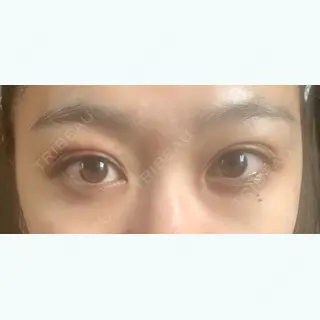 7日目の経過画像（1枚目）