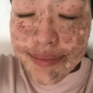 4日目の経過画像（1枚目）