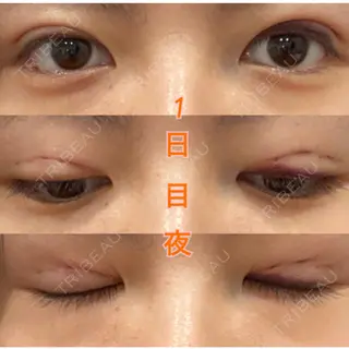 1日目の経過画像（2枚目）