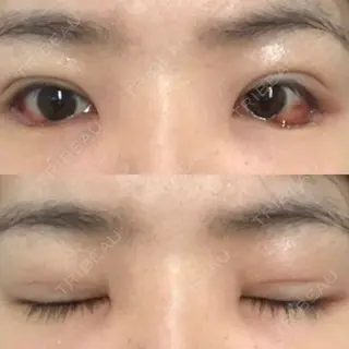 2日目の経過画像（1枚目）