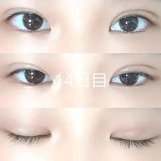 14日目の経過画像（1枚目）