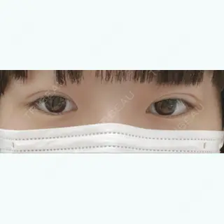 1日目の経過画像（1枚目）