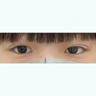 2日目の経過画像（1枚目）