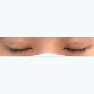 7日目の経過画像（3枚目）