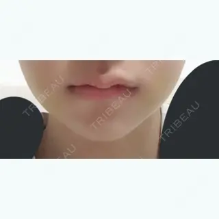 7日目の経過画像（2枚目）