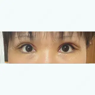 3日目の経過画像（1枚目）