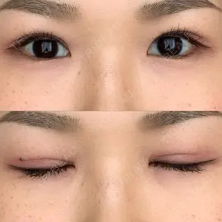 29日目の経過画像（2枚目）