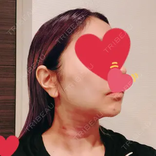 1日目の経過画像（2枚目）