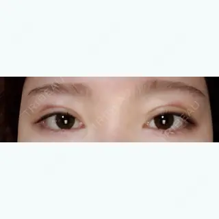 2日目の経過画像（1枚目）