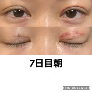 7日目の経過画像（1枚目）