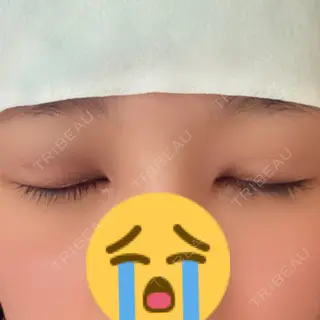 1日目の経過画像（2枚目）