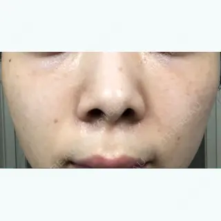 90日目の経過画像（1枚目）