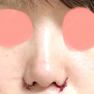0日目の経過画像（1枚目）