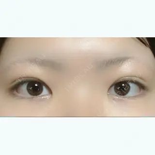 23日目の経過画像（1枚目）