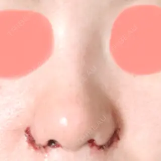 1日目の経過画像（1枚目）
