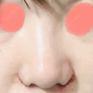 2日目の経過画像（1枚目）