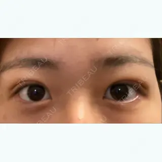 4日目の経過画像（2枚目）