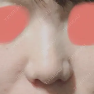 7日目の経過画像（1枚目）