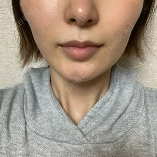 32日目の経過画像（1枚目）