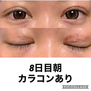 8日目の経過画像（1枚目）