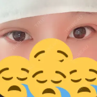 2日目の経過画像（1枚目）