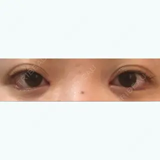 28日目の経過画像（1枚目）