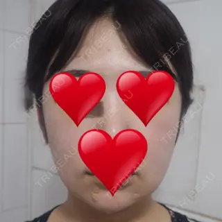 2日目の経過画像（1枚目）