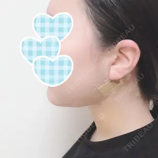 3日目の経過画像（2枚目）