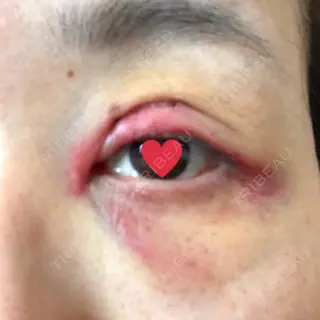 2日目の経過画像（1枚目）