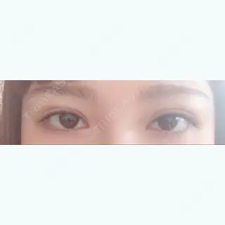 4日目の経過画像（1枚目）