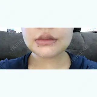 6日目の経過画像（1枚目）