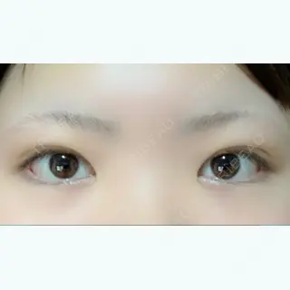 25日目の経過画像（1枚目）