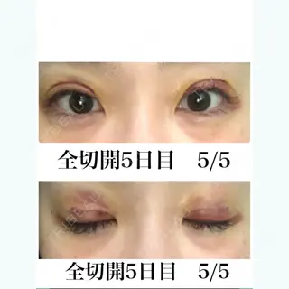5日目の経過画像（1枚目）