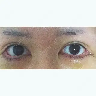 6日目の経過画像（1枚目）