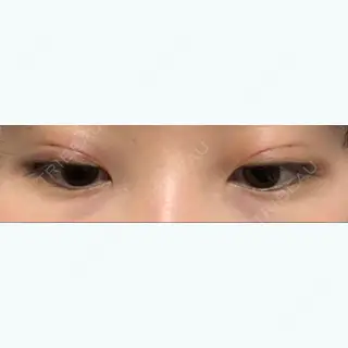 1日目の経過画像（2枚目）