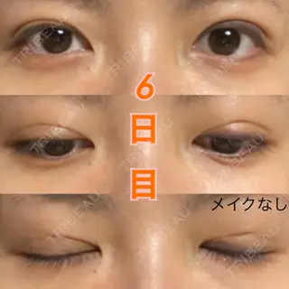 6日目の経過画像（2枚目）