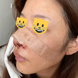 1日目の経過画像（3枚目）