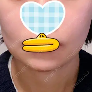 6日目の経過画像（1枚目）