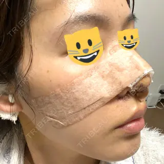 4日目の経過画像（1枚目）