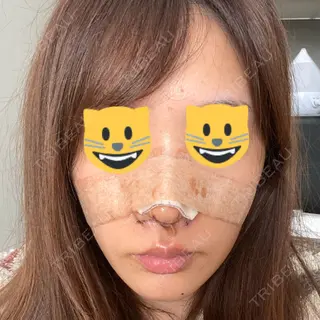5日目の経過画像（1枚目）