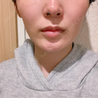 34日目の経過画像（1枚目）