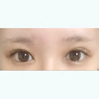 60日目の経過画像（1枚目）