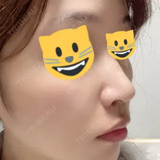 15日目の経過画像（3枚目）