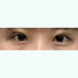 3日目の経過画像（1枚目）