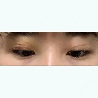 3日目の経過画像（2枚目）