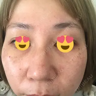 2日目の経過画像（3枚目）