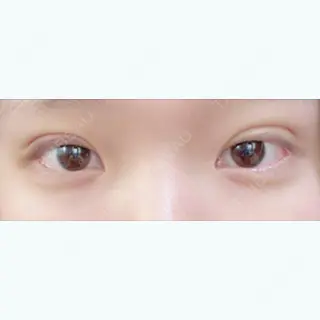 6日目の経過画像（1枚目）