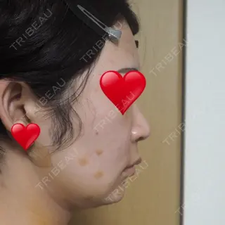 5日目の経過画像（2枚目）
