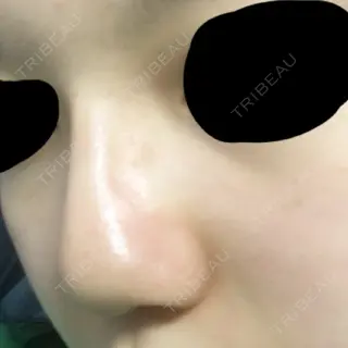 6日目の経過画像（3枚目）