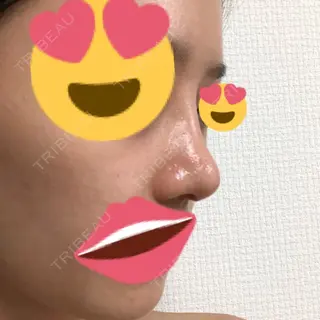 10日目の経過画像（2枚目）